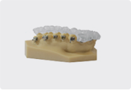 Indirect Bonding Tray Thumb